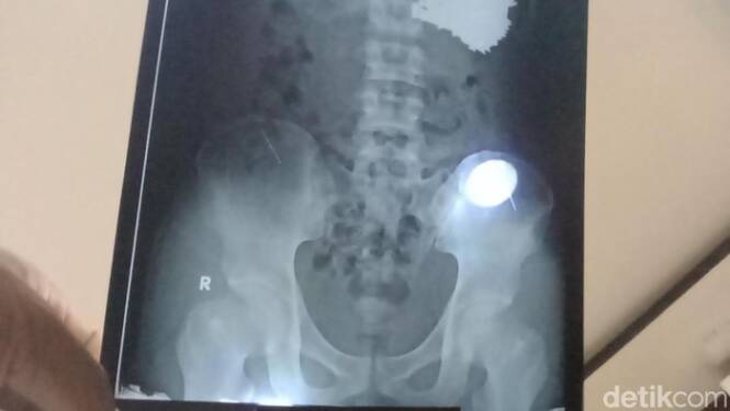 Foto: Paku di Perut