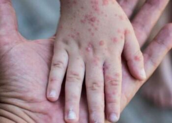 Mematikan, Mpox Merebak di Eropa dan Amerika