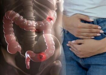 Simak! Ini Pemicu Kanker Usus Besar Melonjak pada Usia Muda
