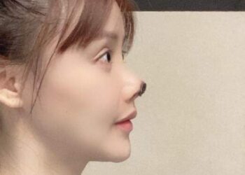 Oplas Gagal, Hidung Aktris Ini Menghitam dan Membusuk