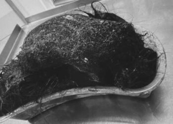 Foto: Dikira Intoleransi Gluten, Gadis 14 Tahun Ternyata Idap Kondisi Langka Akibat Gumpalan Rambut Raksasa di Perut 5