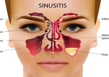 Foto: Kenali Perbedaan Flu Alergi dan Sinusitis Serta Penanganan Medis di Mayapada Hospital Surabaya 6