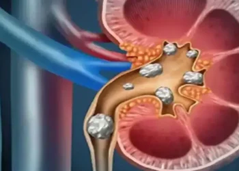 Foto: Mengenal Tanda Penyakit Ginjal Melalui Perubahan Urine dan Deteksi Dini Kebocoran Protein 3
